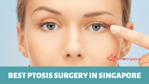 Best Ptosis Surgery in Singapore