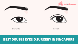 Best Double Eyelid Surgery in Singapore