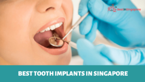 Best Tooth Implants in Singapore
