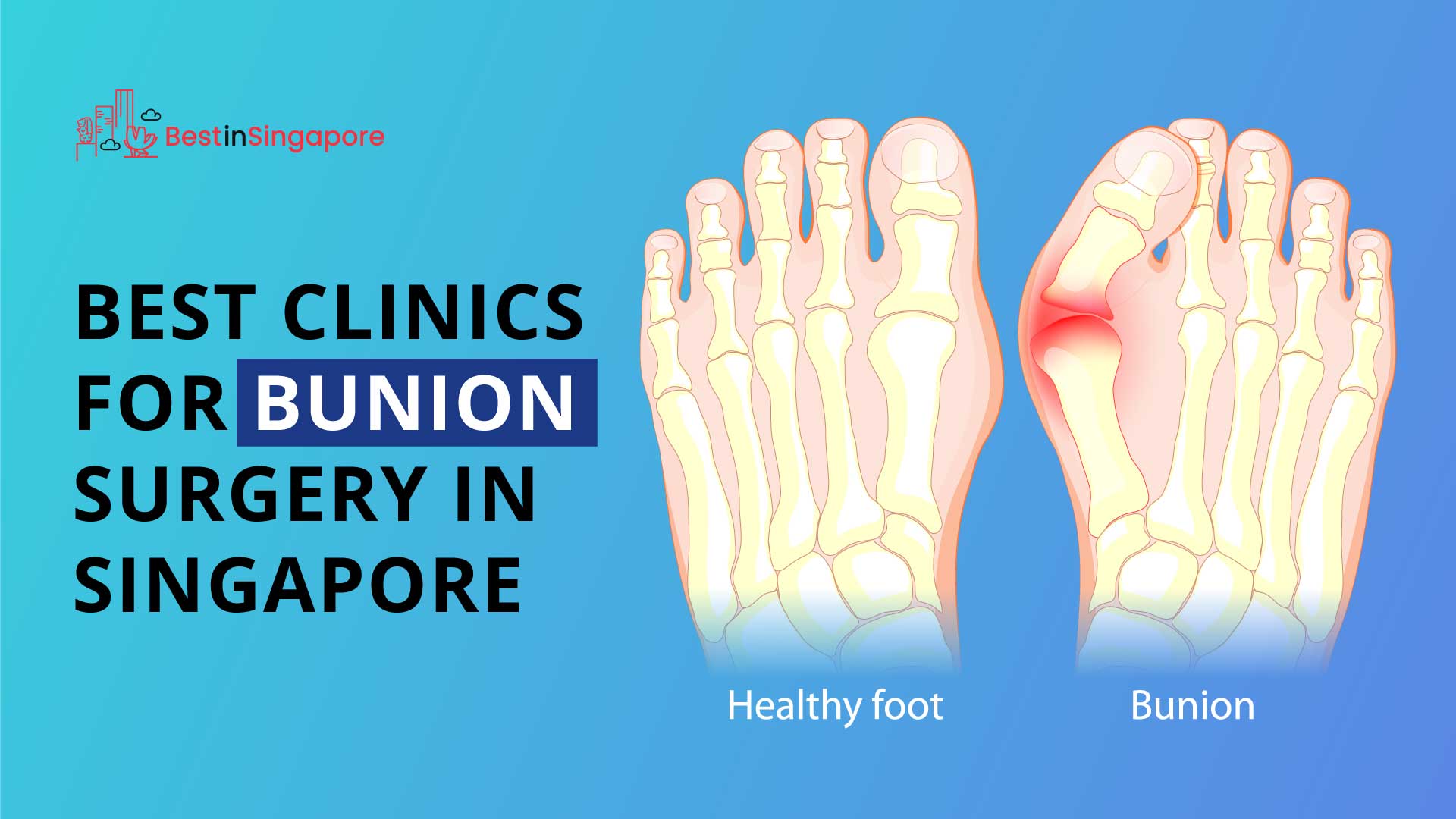 Best Bunion Surgery in Singapore
