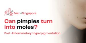 A Quick Guide to Post-Inflammatory Hyperpigmentation
