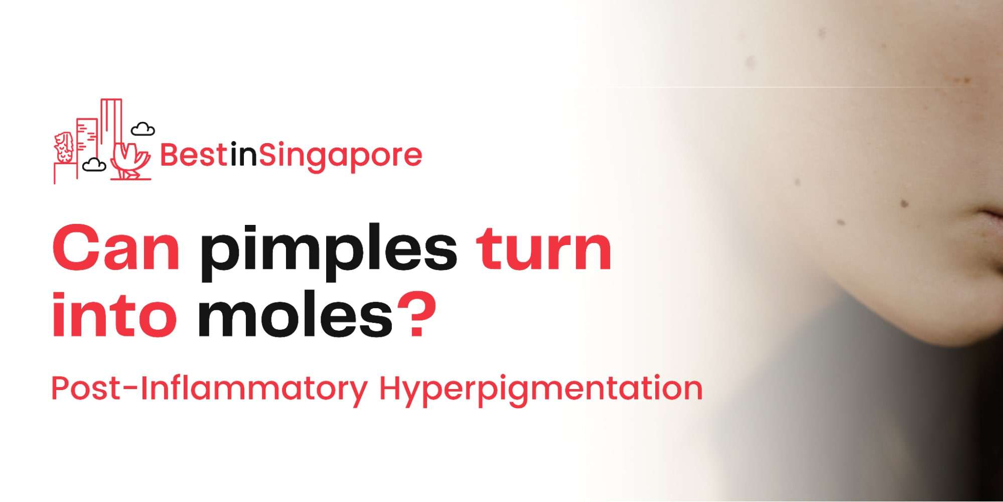 A Quick Guide to Post-Inflammatory Hyperpigmentation