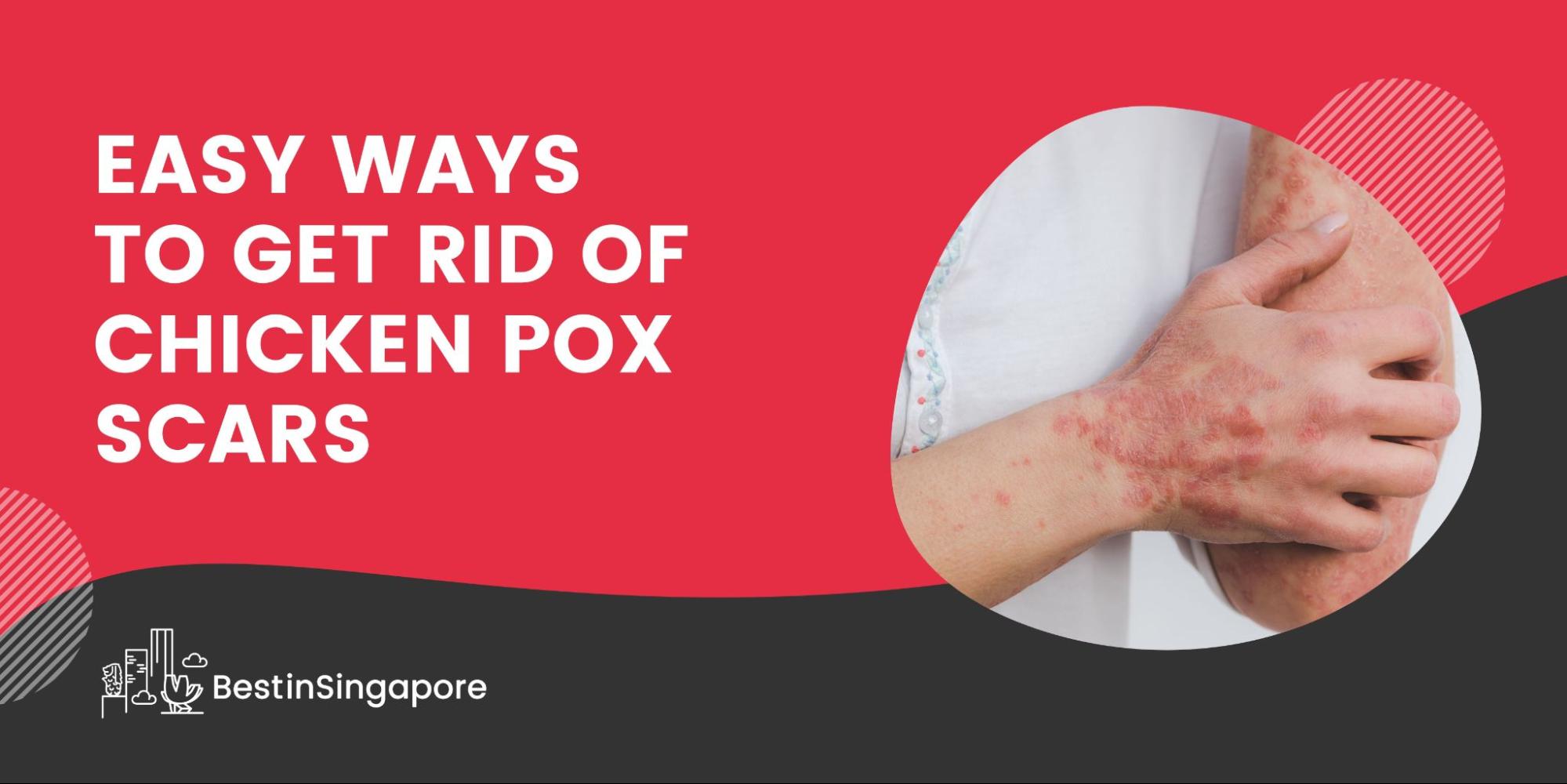 Easy Ways to Get Rid of Chicken Pox Scars