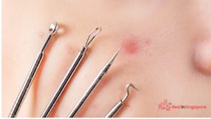 Picking and Popping Pimples
