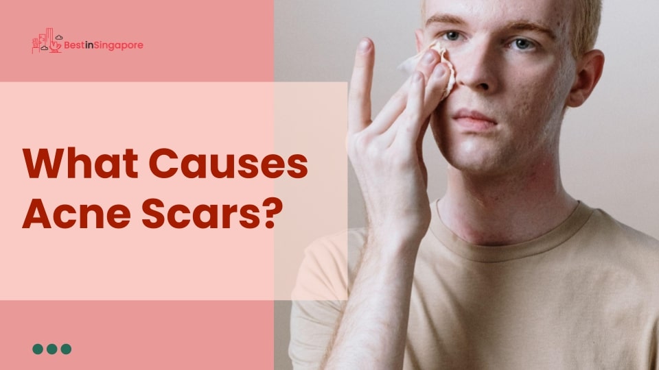 What causes acne scars