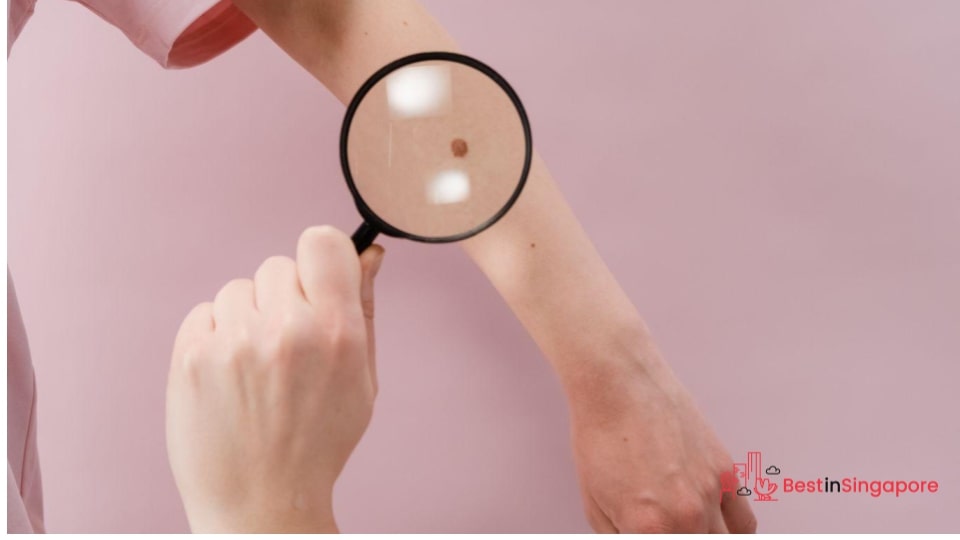 Consider electrocautery for bigger skin tags