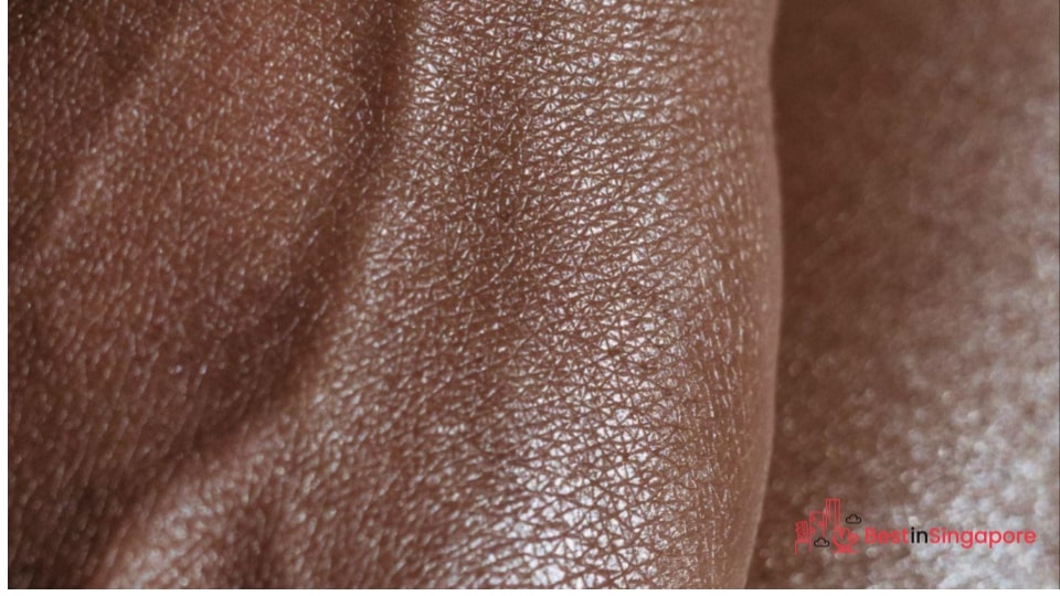 Contact Dermatitis