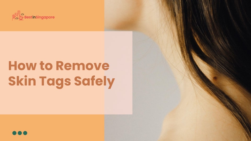 How to Remove Skin Tags Safely
